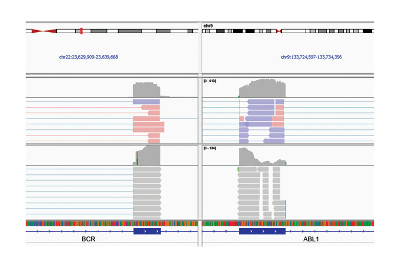 Обнаружение фьюжена гена BCR-ABL1